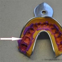 Как делают коронку на зуб, этапы изготовления и установки